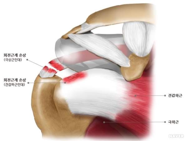 회전근개 파열
